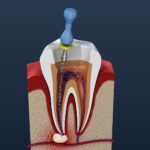 Benefits of Modern Painless Root Canal Treatment in Satara