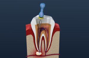 Benefits of Modern Painless Root Canal Treatment in Satara