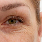 Can Wrinkles Be Removed Without Surgery?