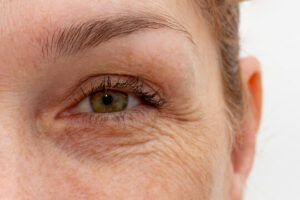 Can Wrinkles Be Removed Without Surgery?