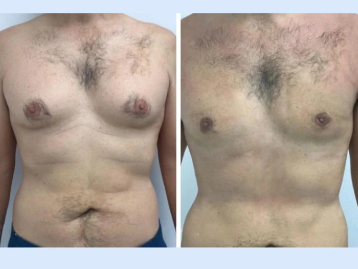 H4 Gynecomastia 1