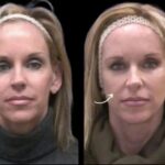 Best Doctors in Dubai Explain Sculptra Treatment Cycles