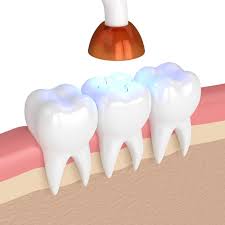 How Tooth Colored Fillings Help Repair Decayed Teeth 1 How Tooth Colored Fillings Help Repair Decayed Teeth