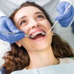 How Many Months Does Orthodontic Treatment Usually Take?