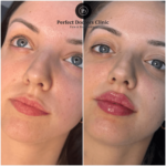 Dermal Filler Brands Compared by the Best Aesthetic Clinics in dubai