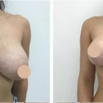 Best Breast Reduction Surgeons in dubai for Customized Breast Reduction Surgery 4 Best Breast Reduction Surgeons in dubai for Customized Breast Reduction Surgery