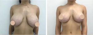 Best Breast Reduction Surgeons in dubai for Customized Breast Reduction Surgery