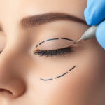 Transform Your Appearance with Blepharoplasty in Islamabad 3 Transform Your Appearance with Blepharoplasty in Islamabad