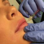 What Makes Restylane Ideal for Non-Surgical Beauty? 3 What Makes Restylane Ideal for Non-Surgical Beauty?