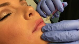 What Makes Restylane Ideal for Non-Surgical Beauty? 1 What Makes Restylane Ideal for Non-Surgical Beauty?