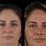 H6 Cheek Fillers 1 1 2