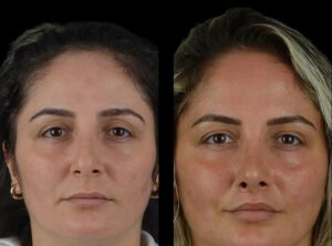 The Best Plastic Surgeon in Dubai Uses Cutting-Edge Techniques for Cheek Fillers
