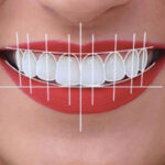 Digital Smile Designing for Uneven Teeth: Is It the Right Solution?
