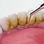 Teeth Cleaning: Your Comprehensive Guide to Maintaining Oral and Dental Health 3 Teeth Cleaning: Your Comprehensive Guide to Maintaining Oral and Dental Health