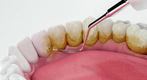 Teeth Cleaning: Your Comprehensive Guide to Maintaining Oral and Dental Health