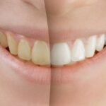 Laser Teeth Whitening vs Bleaching Trays: Understanding the Differences