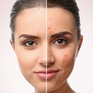 10 Common Myths and Facts About Acne Scar Treatments
