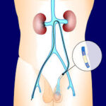 varicocele embolization recovery