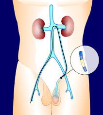 What to Expect During Varicocele Embolization Recovery and Tips for a Smooth Healing Process 1 What to Expect During Varicocele Embolization Recovery and Tips for a Smooth Healing Process