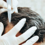 Exosome hair in Dubai 8
