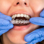 Can Clear Aligners Fix Severe Orthodontic Problems?