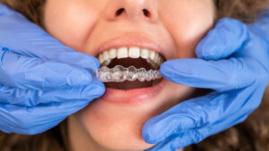 Can Clear Aligners Fix Severe Orthodontic Problems? 1 Can Clear Aligners Fix Severe Orthodontic Problems?