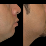 Top Trends in Facial Contouring and Double chin removal Surgery in dubai 3 Top Trends in Facial Contouring and Double chin removal Surgery in dubai