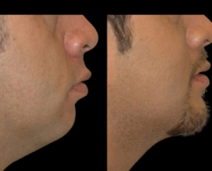 Top Trends in Facial Contouring and Double chin removal Surgery in dubai
