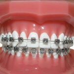How Braces Help Correct Bite Problems in Growing Children