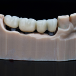 Types of Dental Crowns: Porcelain, Zirconia, Metal, and More 2 Types of Dental Crowns: Porcelain, Zirconia, Metal, and More