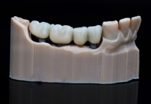 Types of Dental Crowns: Porcelain, Zirconia, Metal, and More 1 Types of Dental Crowns: Porcelain, Zirconia, Metal, and More
