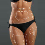Is Vaser 4D Liposuction the ultimate path to body precision? 3 Is Vaser 4D Liposuction the ultimate path to body precision?