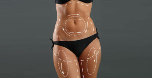 Is Vaser 4D Liposuction the ultimate path to body precision?