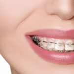Badlapur Braces Treatment Costs: What Every Patient Should Expect