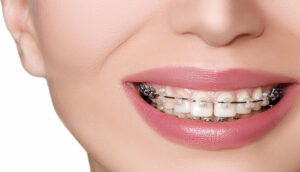 Badlapur Braces Treatment Costs: What Every Patient Should Expect