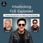 Interlocking FUE Explained: A New Perspective on Natural Hair Density