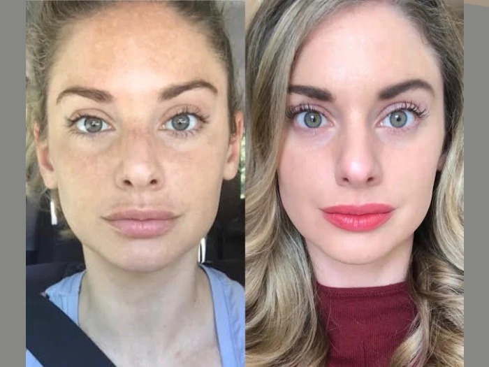 Radiofrequency RF Microneedling in Dubai