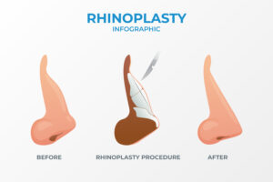 Rhinoplasty 101: Everything You Need to Know Before Your Nose Job 1 Rhinoplasty 101: Everything You Need to Know Before Your Nose Job