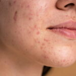 Which Acne Treatment Is Right for Your Skin Type?