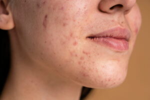 Which Acne Treatment Is Right for Your Skin Type?