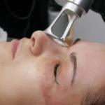 Skin Revival Edge fractional C02 Laser Treatment Laser Skin Lift 3 Skin Revival Edge fractional C02 Laser Treatment Laser Skin Lift