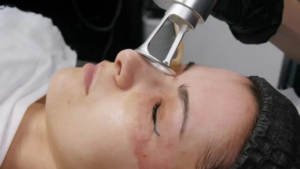 Skin Revival Edge fractional C02 Laser Treatment Laser Skin Lift