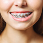 What Influences Braces Treatment Cost in Bhandara More Than You Expect 3 What Influences Braces Treatment Cost in Bhandara More Than You Expect