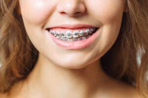 What Influences Braces Treatment Cost in Bhandara More Than You Expect 1 What Influences Braces Treatment Cost in Bhandara More Than You Expect
