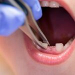 The Role of Tooth Extraction in Pediatric Orthodontic Treatment 3 The Role of Tooth Extraction in Pediatric Orthodontic Treatment