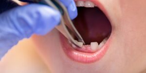 The Role of Tooth Extraction in Pediatric Orthodontic Treatment