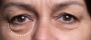 Eye Bag Removal can it reduce eye bags for clean look? 1 Eye Bag Removal can it reduce eye bags for clean look?