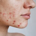 Clearer Skin Through Advanced Acne Treatment in Dubai 3 Clearer Skin Through Advanced Acne Treatment in Dubai