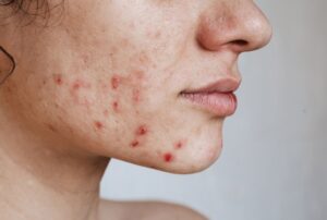 Clearer Skin Through Advanced Acne Treatment in Dubai 1 Clearer Skin Through Advanced Acne Treatment in Dubai