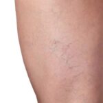 Effective Spider Veins Treatment In Dubai for Smooth and Clear Skin Appearance 3 Effective Spider Veins Treatment In Dubai for Smooth and Clear Skin Appearance